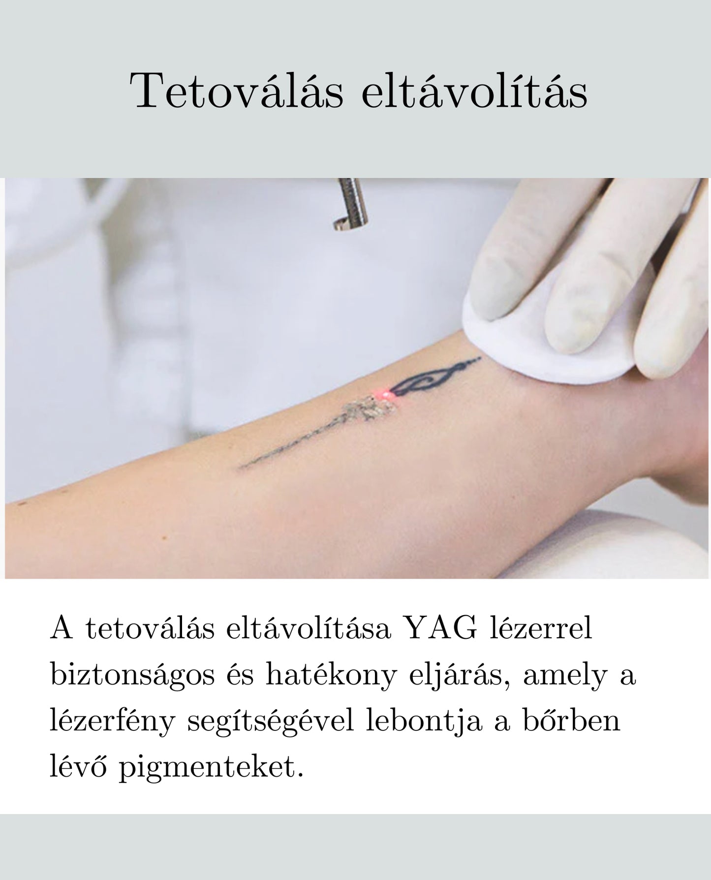 Tattoo removal
