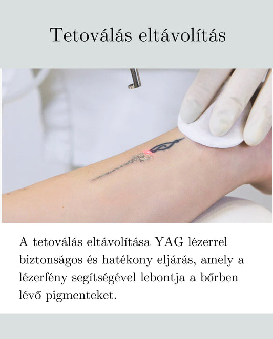 Tattoo removal
