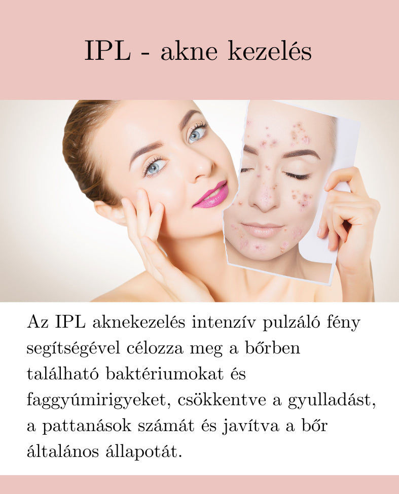 IPL - akne, heg kezelés