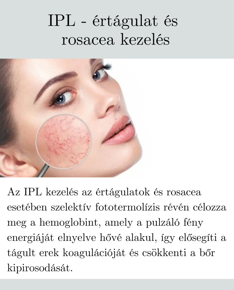 IPL - értágulat és rosacea kezelés
