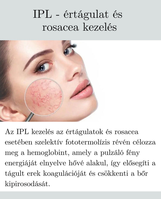 IPL - értágulat és rosacea kezelés