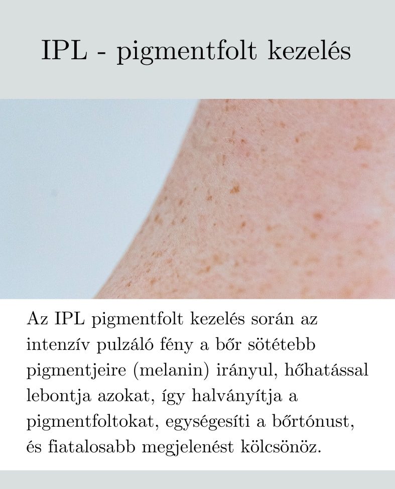IPL - pigmentfolt kezelés
